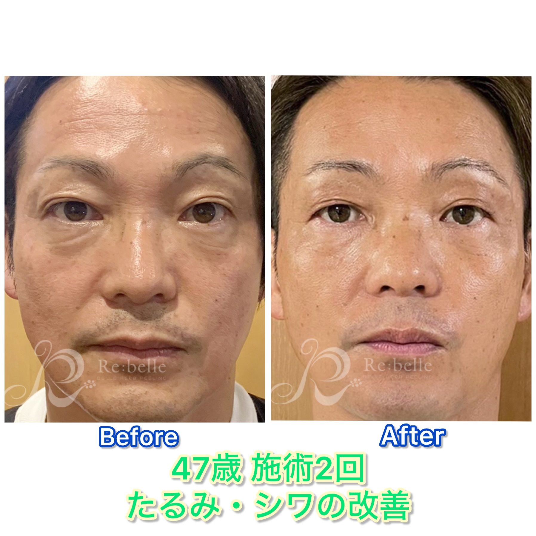 ハーブピーリング施術後の肌質改善ビフォーアフター
