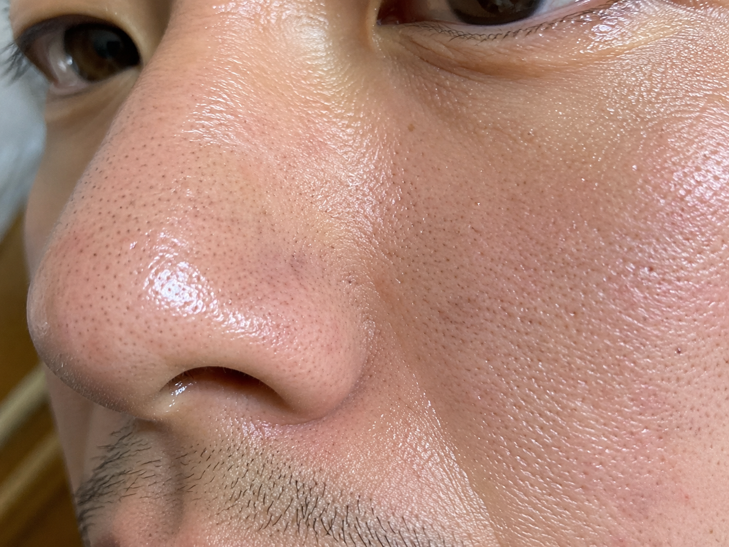 男性の脂っぽいTゾーン・毛穴詰まりの肌状態